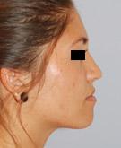 Après l'intervention : Rhinoplastie