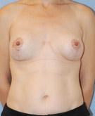 Après l'intervention : Reconstruction mammaire