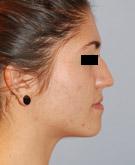 Avant l'intervention : Rhinoplastie