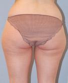 Avant l'intervention : Liposuccion